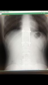 胸椎・腰椎脱臼骨折のリハビリトレーニング