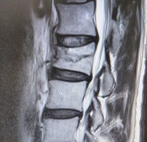 【腰椎圧迫骨折】出張パーソナルトレーニング×ボディケア